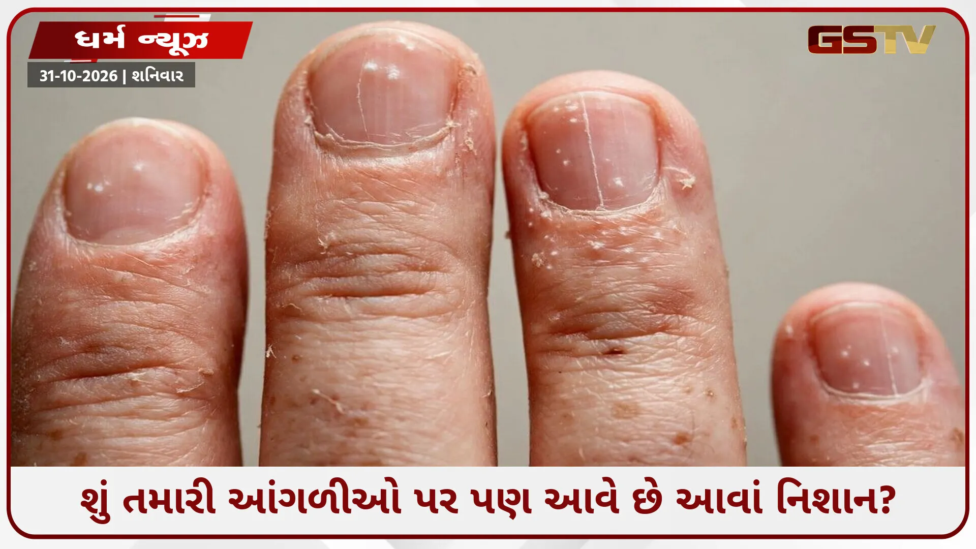 તમારી આંગળીઓ પર કેમ થાય છે આવાં નિશાન? આ ચોંકાવનારૂં કારણ જાણીને દંગ રહી જશો!